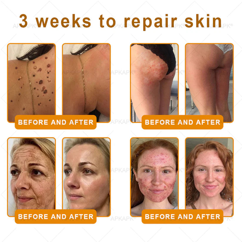 APKAP®Bee venomSkin Restoration Creaml💎💎 Powerful anti-aging solution that targets deepwrinkles,fine lines,sagging skin,and dryness