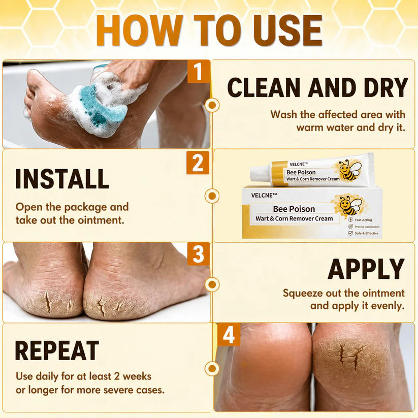 👩‍⚕️Velcne™Bee Poison Wart & Corn Remover Cream