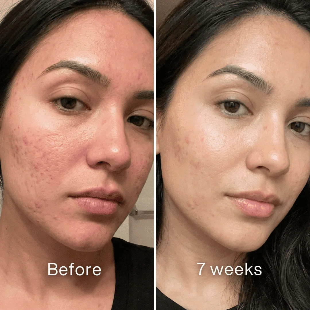✨ LAST DAY BUY 1 GET 1 FREE✨Cheapsu™ Clinical Acne Scar Remodeling Stick
