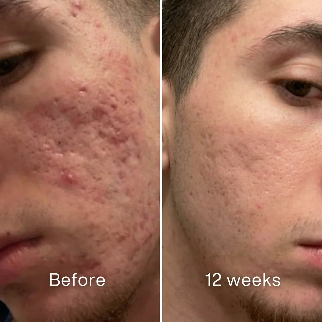✨ LAST DAY BUY 1 GET 1 FREE✨Cheapsu™ Clinical Acne Scar Remodeling Stick