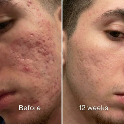 ✨ LAST DAY BUY 1 GET 1 FREE✨Cheapsu™ Clinical Acne Scar Remodeling Stick