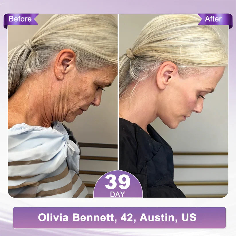 💖 LAST DAY BUY 1 GET 1 FREE💖 HISKIN PDRN Visibly Firmer Anti-aging, Lifted Skin in 72 Hours — No Needles, No Clinic Visits