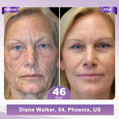 💖 LAST DAY BUY 1 GET 1 FREE💖 HISKIN PDRN Visibly Firmer Anti-aging, Lifted Skin in 72 Hours — No Needles, No Clinic Visits